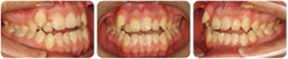 种植钉多维运用矫正高角反颌及开颌—对罗晨医生专访及病例展示（上）