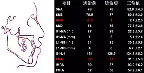 种植钉多维运用矫正高角反颌及开颌—对罗晨医生专访及病例展示（上）