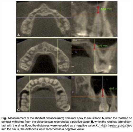正畸文献阅读--不同骨型患者上颌后牙根尖至上颌窦底距离的研究
