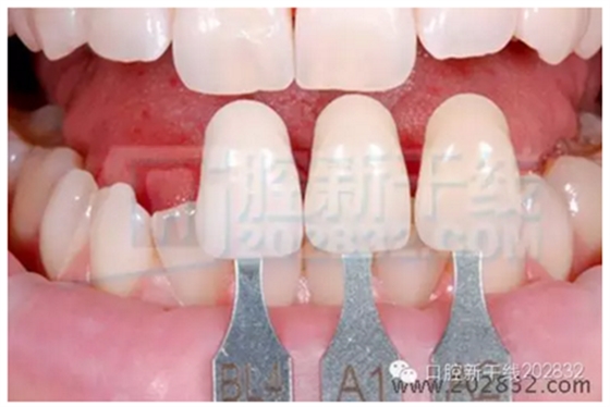 义获嘉 Ivoclar Vivadent 比色板 A-D16色 Ivoclar Shade Guide A-D16