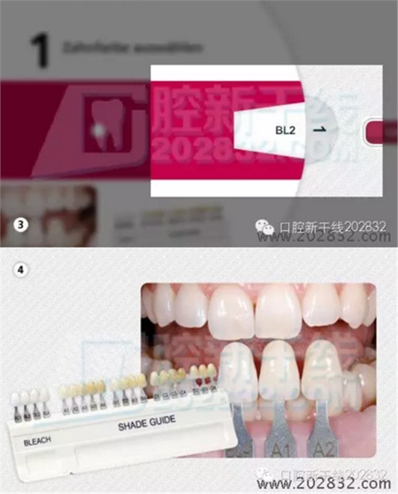 义获嘉 Ivoclar Vivadent 比色板 A-D16色 Ivoclar Shade Guide A-D16