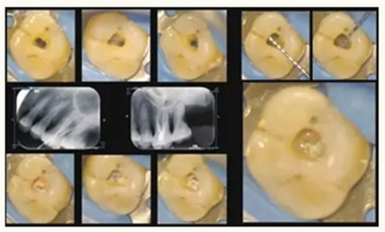 显微知著 从齿开始——上海第九人民医院牙体牙髓科 显微知著 从齿开始——上海第九人民医院牙体牙髓科