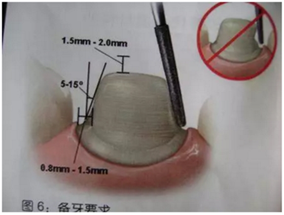 医生，我的烤瓷牙上有个黑线怎么回事？