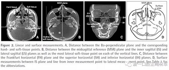 正畸文献阅读--无症状单侧唇腭裂患者面中部不对称的三维分析