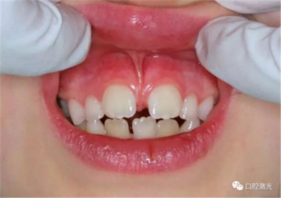 口腔激光在系带延长术中的应用