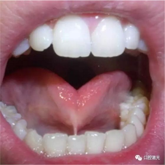 口腔激光在系带延长术中的应用