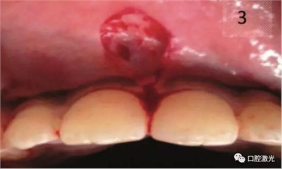 口腔激光在系带延长术中的应用