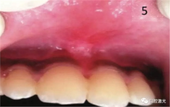 口腔激光在系带延长术中的应用