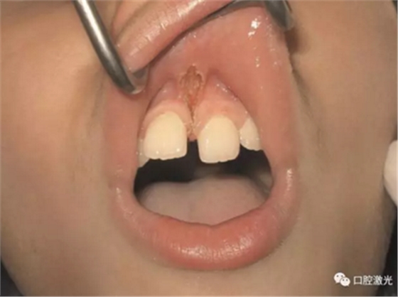 口腔激光在系带延长术中的应用