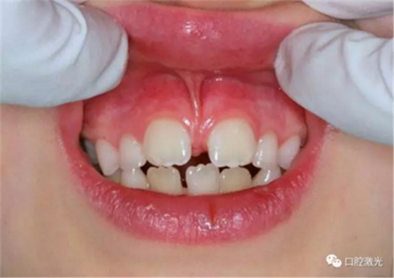 【案例】口腔激光辅助儿童口腔系带整形概述在儿童口腔治疗中，最大的挑战就是儿童对疼痛、治疗器械、噪声以及其他所有陌生事物的恐惧心理。