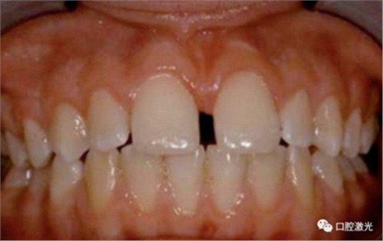 【案例】口腔激光辅助儿童口腔系带整形概述在儿童口腔治疗中，最大的挑战就是儿童对疼痛、治疗器械、噪声以及其他所有陌生事物的恐惧心理。