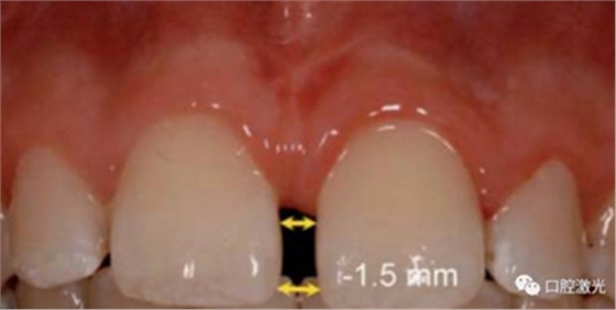 【案例】口腔激光辅助儿童口腔系带整形概述在儿童口腔治疗中，最大的挑战就是儿童对疼痛、治疗器械、噪声以及其他所有陌生事物的恐惧心理。