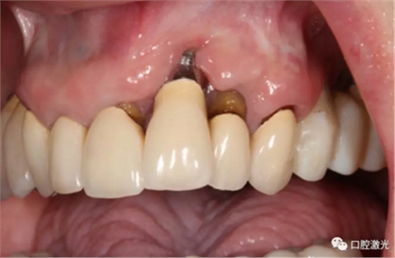 种植体周围炎的激光疗法