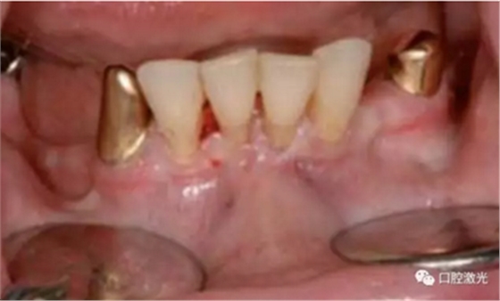 种植医生如何用好口腔激光