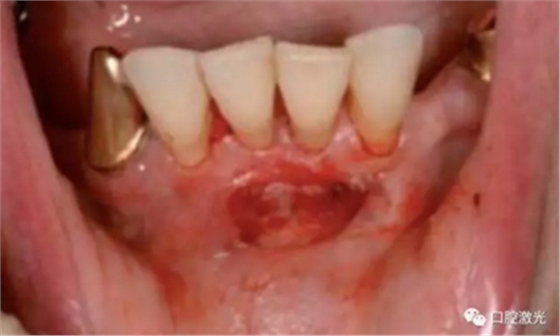 种植医生如何用好口腔激光