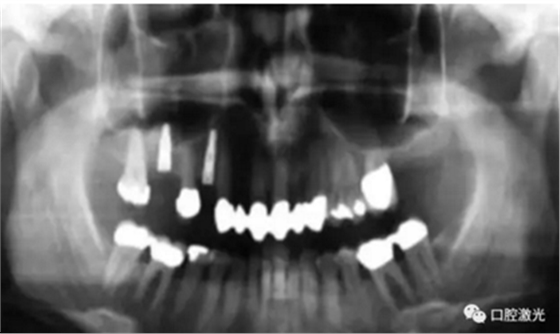 种植医生如何用好口腔激光