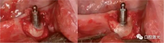 种植医生如何用好口腔激光