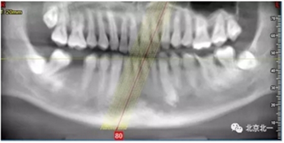 多学科病例分析---正畸、种植、微创拔牙多学科交叉病例