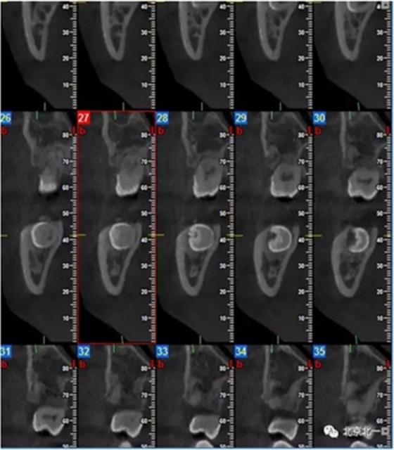 多学科病例分析---正畸、种植、微创拔牙多学科交叉病例