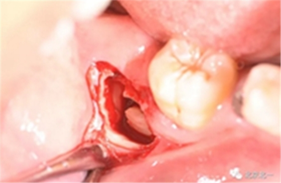 多学科病例分析---正畸、种植、微创拔牙多学科交叉病例