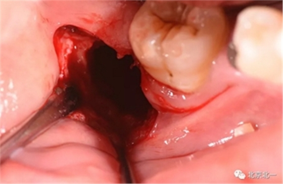 多学科病例分析---正畸、种植、微创拔牙多学科交叉病例