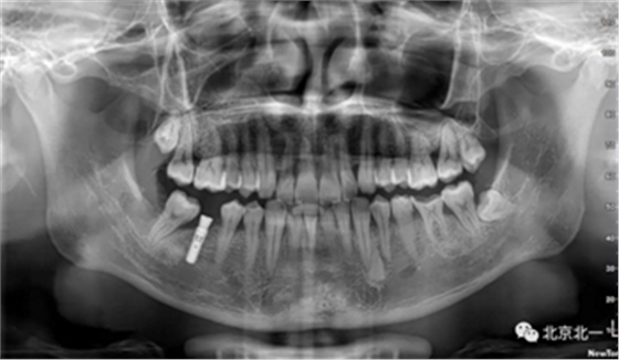 多学科病例分析---正畸、种植、微创拔牙多学科交叉病例