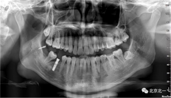 多学科病例分析---正畸、种植、微创拔牙多学科交叉病例
