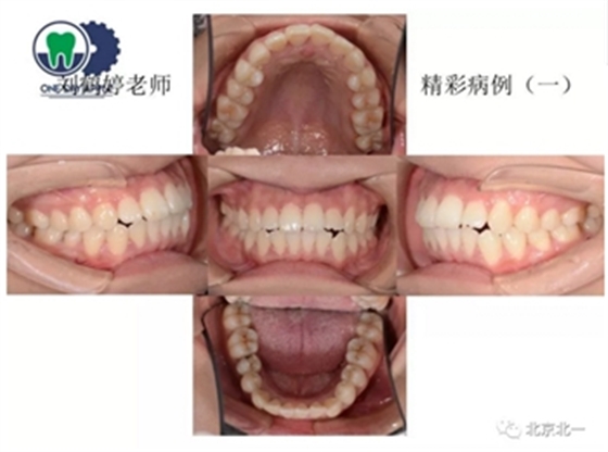 多学科病例分析---正畸、种植、微创拔牙多学科交叉病例