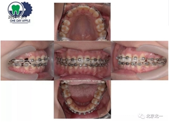 多学科病例分析---正畸、种植、微创拔牙多学科交叉病例