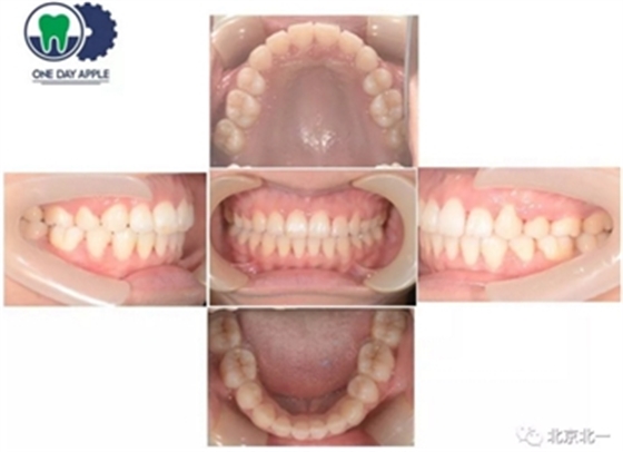 多学科病例分析---正畸、种植、微创拔牙多学科交叉病例