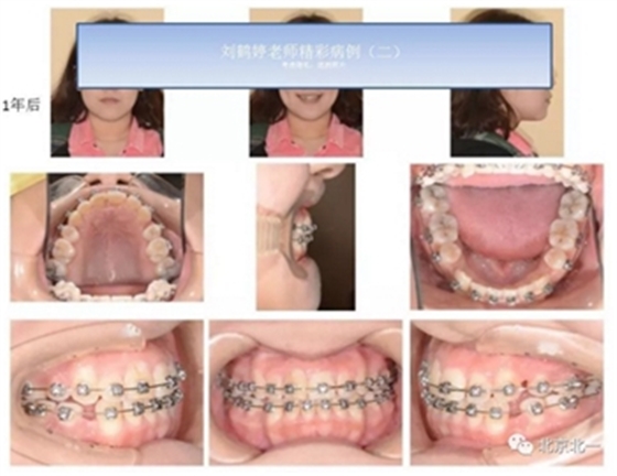 多学科病例分析---正畸、种植、微创拔牙多学科交叉病例