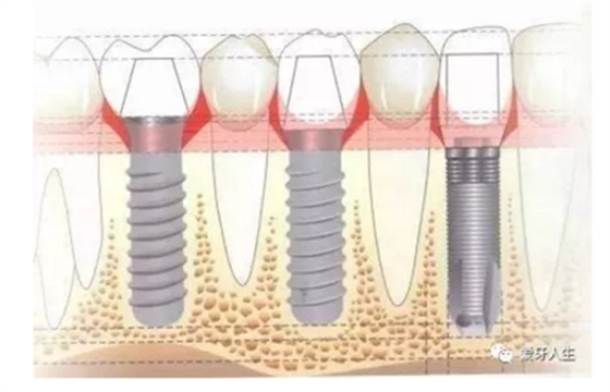 如何选择种植牙，给《患者》推荐这篇文章就足矣
