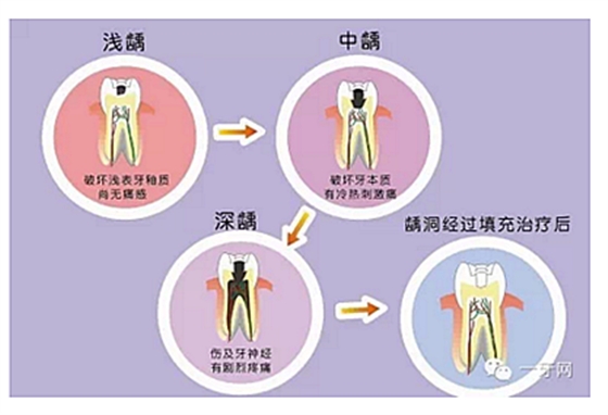 详解牙疼的原因分几种？