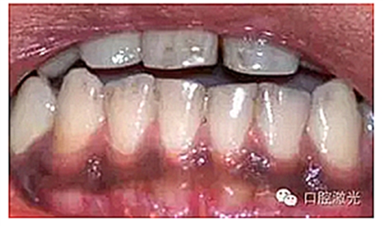 为什么我的牙龈会发黑?该如何治疗? 为什么我的牙龈会发黑?该如何治疗?