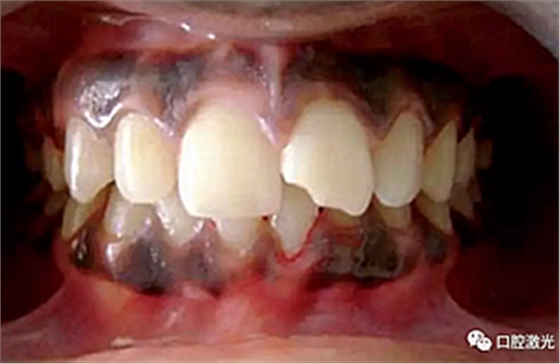 为什么我的牙龈会发黑?该如何治疗? 为什么我的牙龈会发黑?该如何治疗?