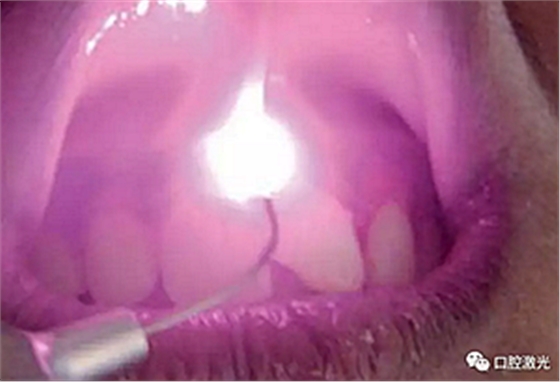 为什么我的牙龈会发黑?该如何治疗? 为什么我的牙龈会发黑?该如何治疗?