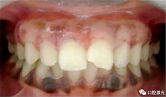 为什么我的牙龈会发黑?该如何治疗? 为什么我的牙龈会发黑?该如何治疗?