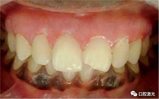 为什么我的牙龈会发黑?该如何治疗? 为什么我的牙龈会发黑?该如何治疗?