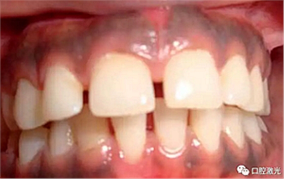 为什么我的牙龈会发黑?该如何治疗? 为什么我的牙龈会发黑?该如何治疗?