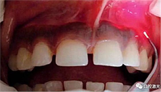 为什么我的牙龈会发黑?该如何治疗? 为什么我的牙龈会发黑?该如何治疗?