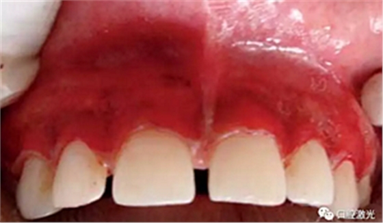 为什么我的牙龈会发黑?该如何治疗? 为什么我的牙龈会发黑?该如何治疗?