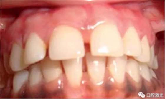 为什么我的牙龈会发黑?该如何治疗? 为什么我的牙龈会发黑?该如何治疗?