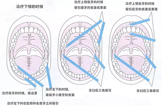 【齿科助手】诊疗时辅助基本