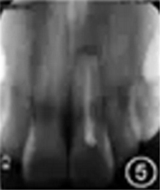 【病例讨论】根管治疗失败患牙再治疗一例（上）