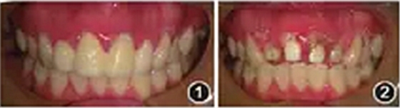 【病例讨论】根管治疗失败患牙再治疗一例（上）
