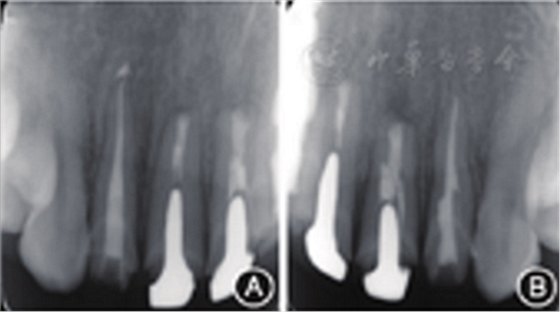 【病例讨论】根管治疗失败患牙再治疗一例（下）