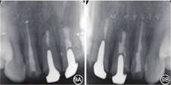 【病例讨论】根管治疗失败患牙再治疗一例（下）