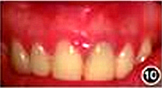 【病例讨论】根管治疗失败患牙再治疗一例（下）