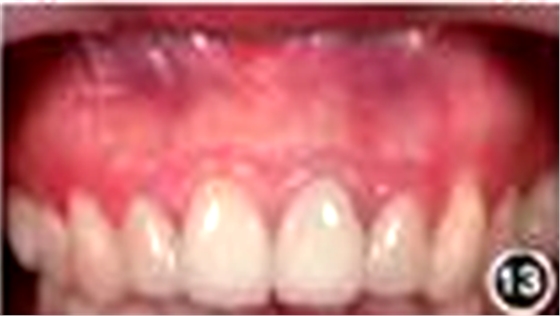 【病例讨论】根管治疗失败患牙再治疗一例（下）