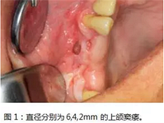 上颌窦瘘修补术——改良式旋转带蒂粘膜瓣修补术的应用